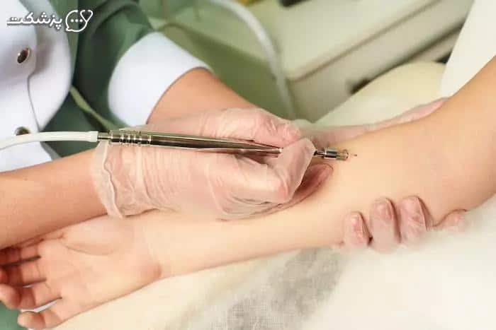 جراحی و لیزر خال- پزشکت